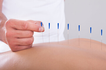 Chiropractor in Shrewsbury, MO - Acupuncture